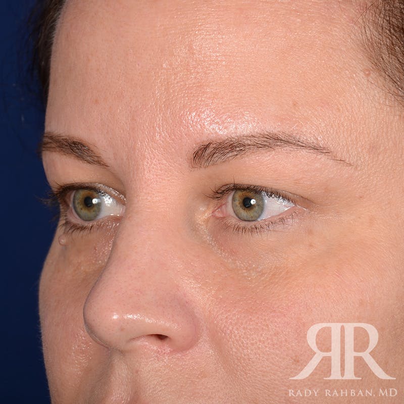 Browlift Before & After Gallery - Patient 229039 - Image 3