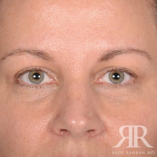 Browlift Before & After Gallery - Patient 229039 - Image 2