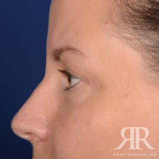 Browlift Before & After Gallery - Patient 229039 - Image 6