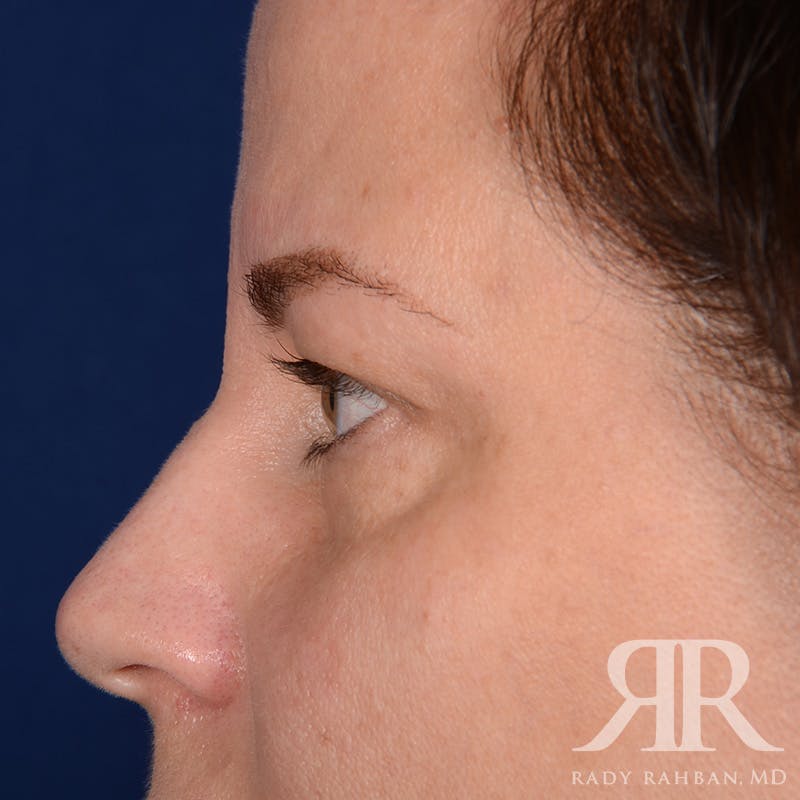 Browlift Before & After Gallery - Patient 229039 - Image 5