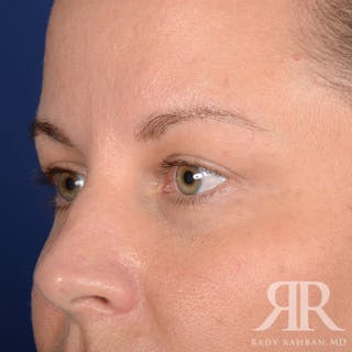 Browlift Before & After Gallery - Patient 229039 - Image 4