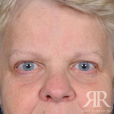Browlift Before & After Gallery - Patient 482903 - Image 1