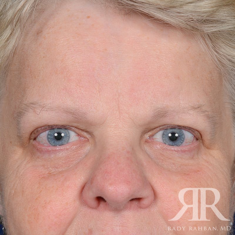 Browlift Before & After Gallery - Patient 482903 - Image 1
