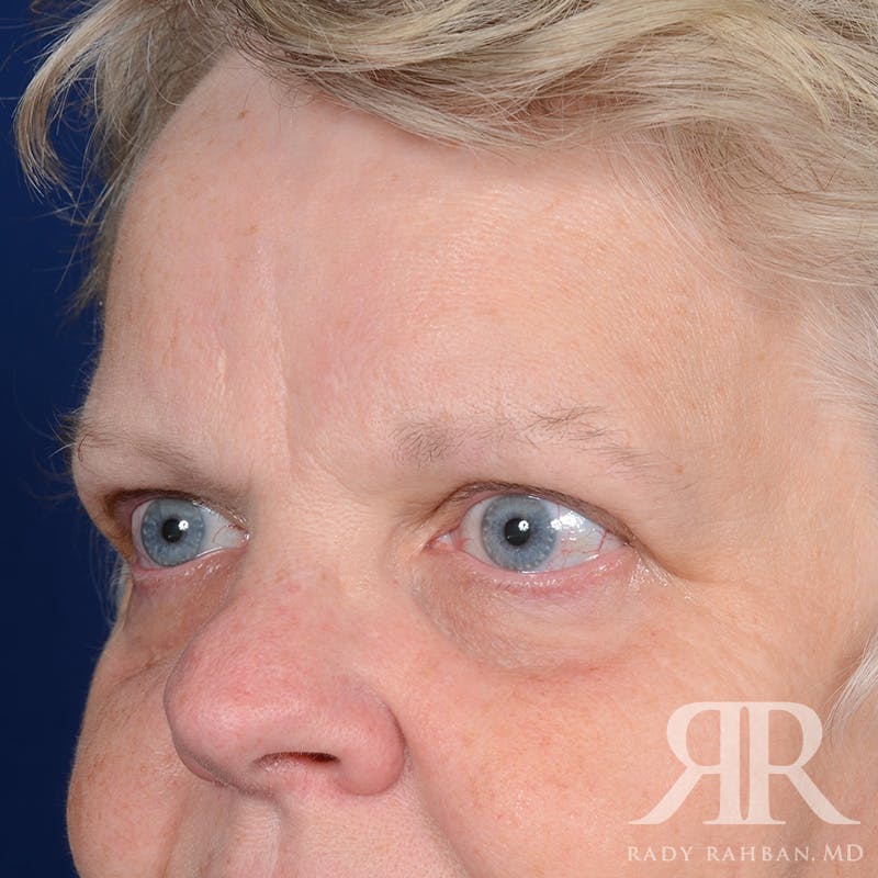 Browlift Before & After Gallery - Patient 482903 - Image 3