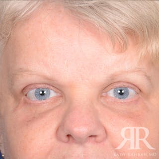 Browlift Before & After Gallery - Patient 482903 - Image 2