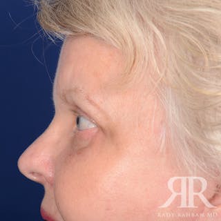 Browlift Before & After Gallery - Patient 482903 - Image 6