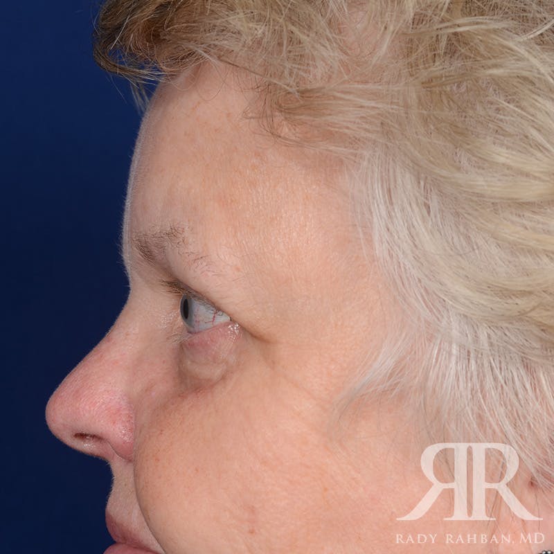 Browlift Before & After Gallery - Patient 482903 - Image 5