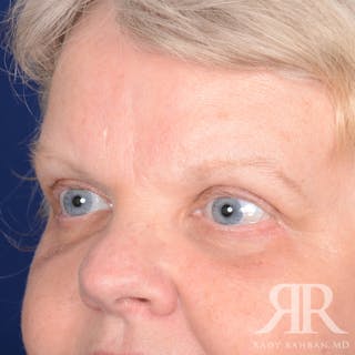 Browlift Before & After Gallery - Patient 482903 - Image 4