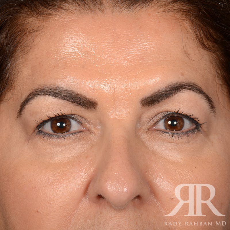 Browlift Before & After Gallery - Patient 287602 - Image 1