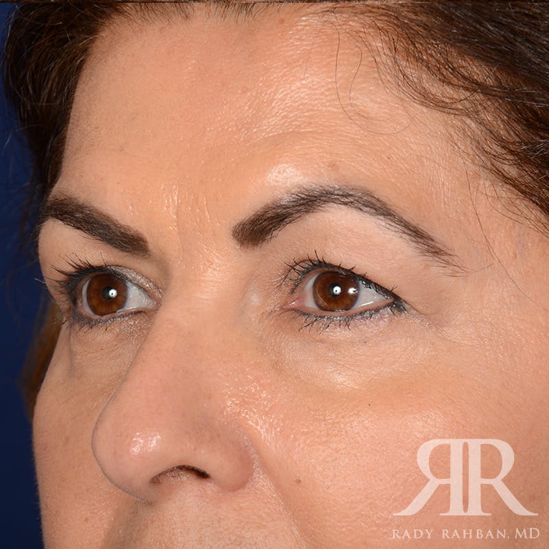 Browlift Before & After Gallery - Patient 287602 - Image 3