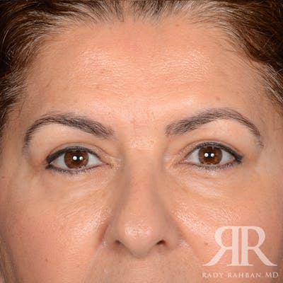Browlift Before & After Gallery - Patient 287602 - Image 2