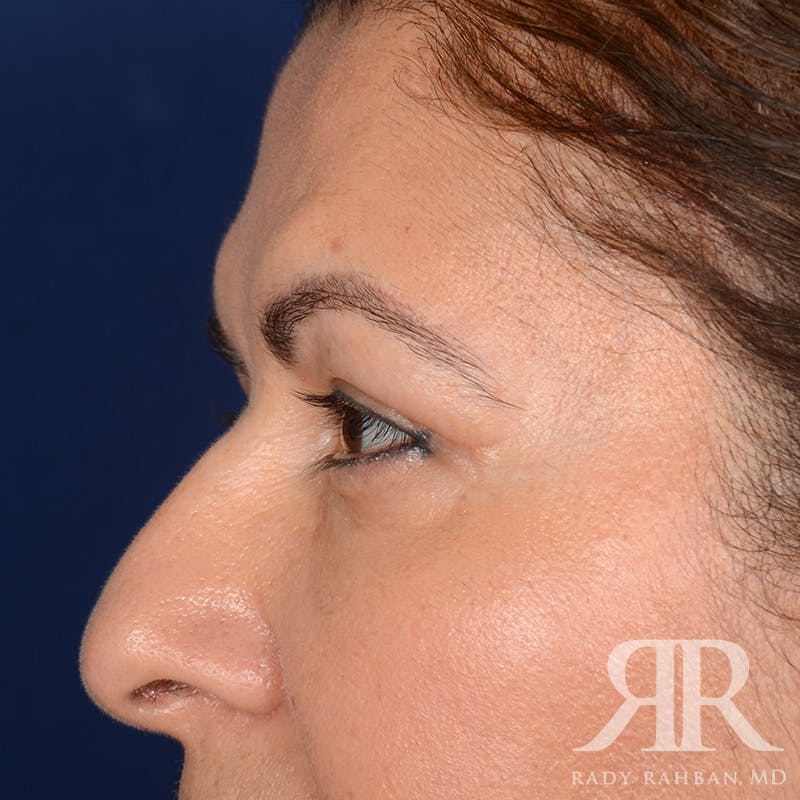 Browlift Before & After Gallery - Patient 287602 - Image 6
