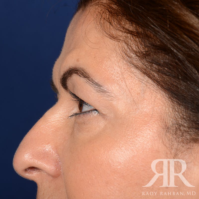 Browlift Before & After Gallery - Patient 287602 - Image 5