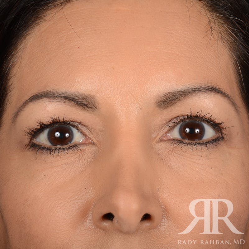 Browlift Before & After Gallery - Patient 131588 - Image 1