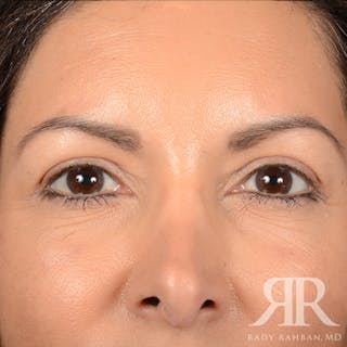 Browlift Before & After Gallery - Patient 131588 - Image 2