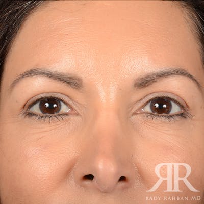 Browlift Before & After Gallery - Patient 131588 - Image 2