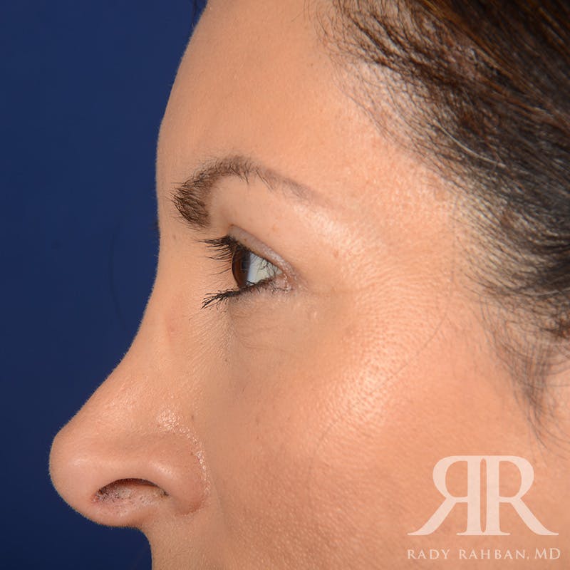 Browlift Before & After Gallery - Patient 131588 - Image 6