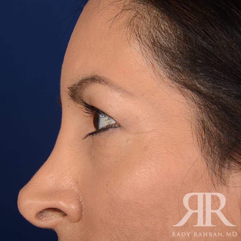 Browlift Before & After Gallery - Patient 131588 - Image 5