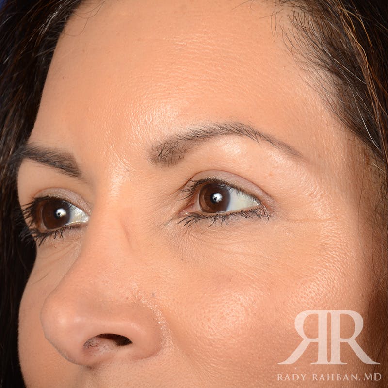 Browlift Before & After Gallery - Patient 131588 - Image 4