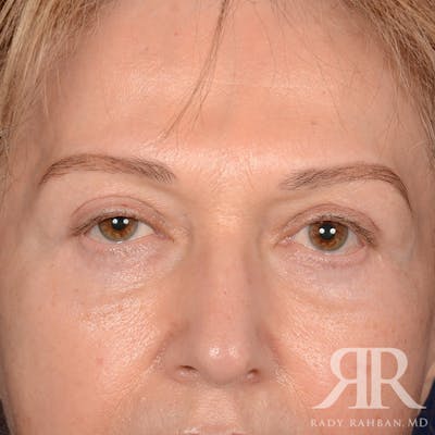 Browlift Before & After Gallery - Patient 364810 - Image 1