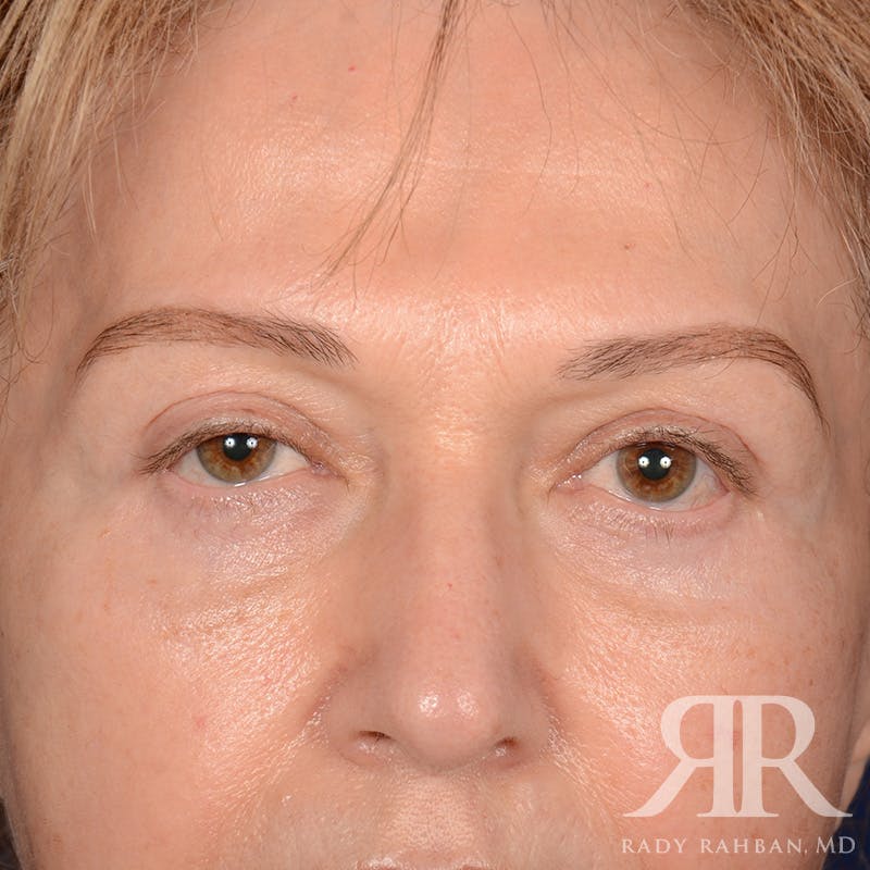 Browlift Before & After Gallery - Patient 364810 - Image 1