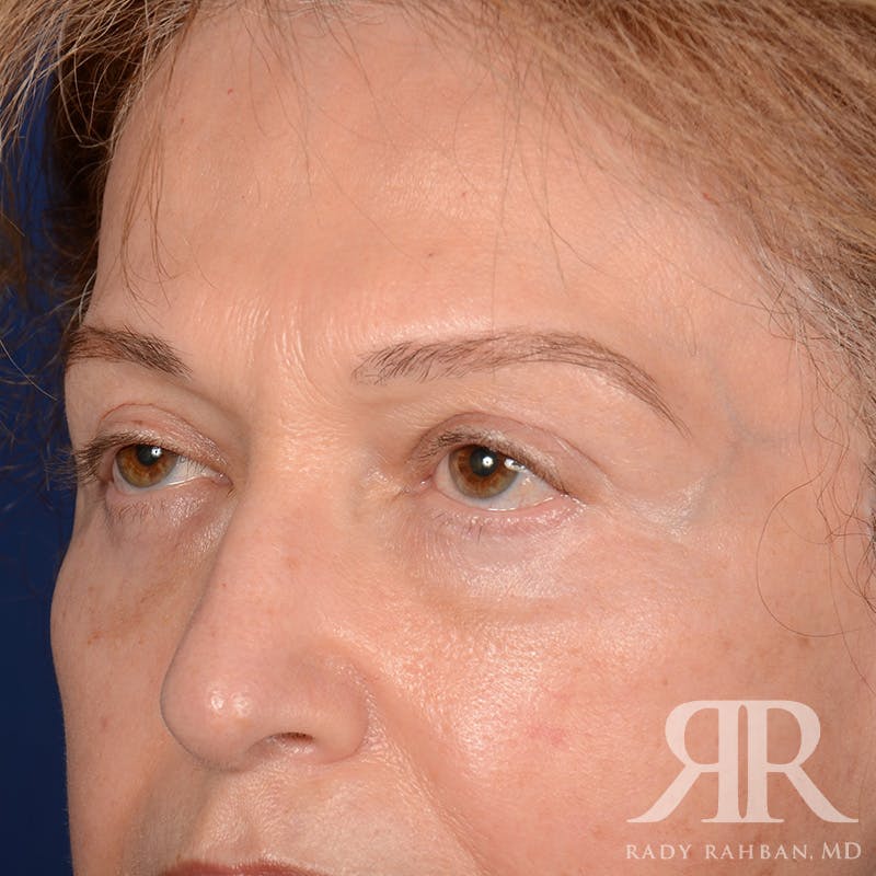 Browlift Before & After Gallery - Patient 364810 - Image 3