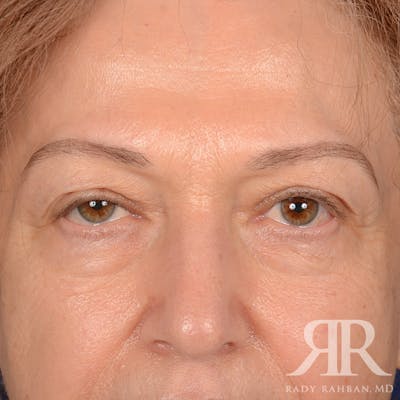 Browlift Before & After Gallery - Patient 364810 - Image 2