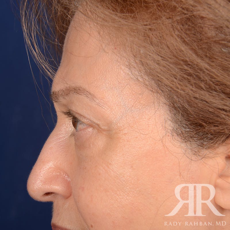 Browlift Before & After Gallery - Patient 364810 - Image 6