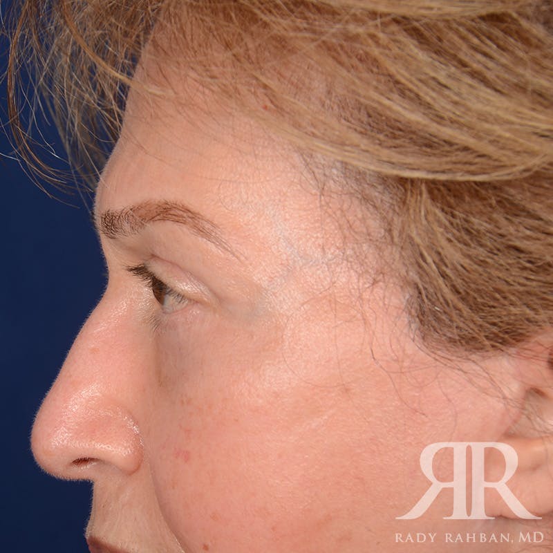 Browlift Before & After Gallery - Patient 364810 - Image 5