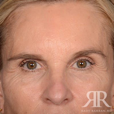 Browlift Before & After Gallery - Patient 988413 - Image 1