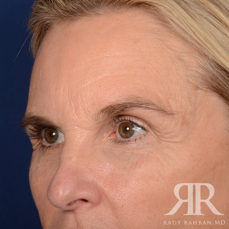 Browlift Before & After Gallery - Patient 988413 - Image 3