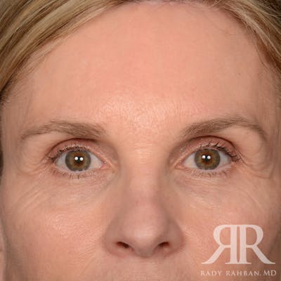 Browlift Before & After Gallery - Patient 988413 - Image 2