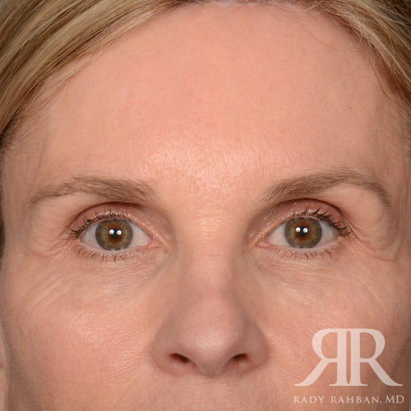 Browlift Before & After Gallery - Patient 988413 - Image 2