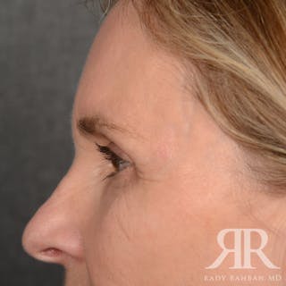 Browlift Before & After Gallery - Patient 988413 - Image 6