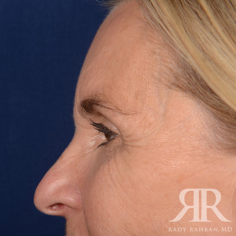 Browlift Before & After Gallery - Patient 988413 - Image 5