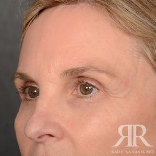 Browlift Before & After Gallery - Patient 988413 - Image 4