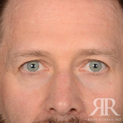 Browlift Before & After Gallery - Patient 300062 - Image 1