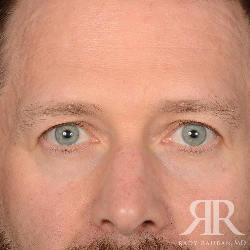 Browlift Before & After Gallery - Patient 300062 - Image 1