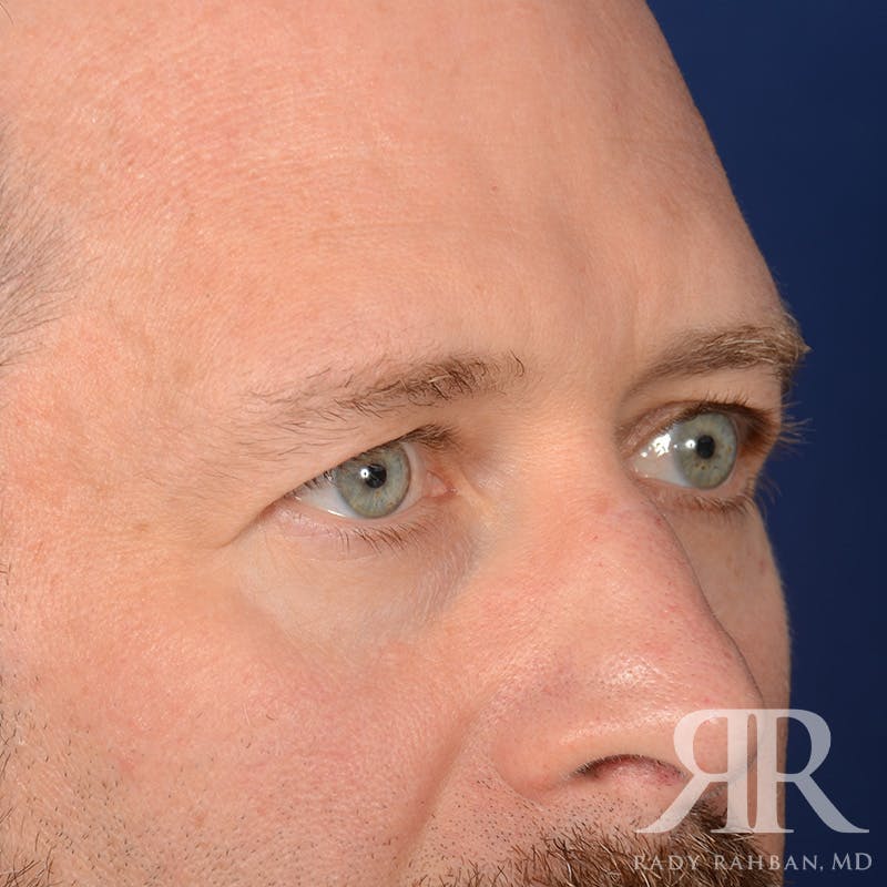 Browlift Before & After Gallery - Patient 300062 - Image 3