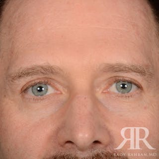 Browlift Before & After Gallery - Patient 300062 - Image 2