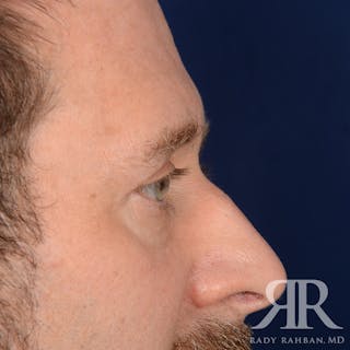 Browlift Before & After Gallery - Patient 300062 - Image 6