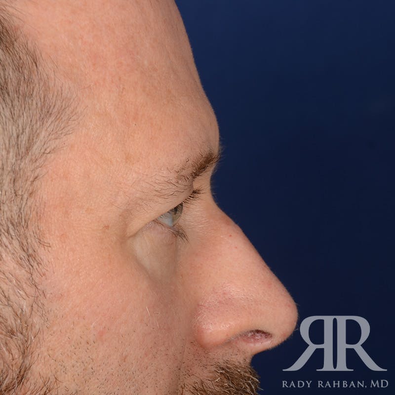 Browlift Before & After Gallery - Patient 300062 - Image 5