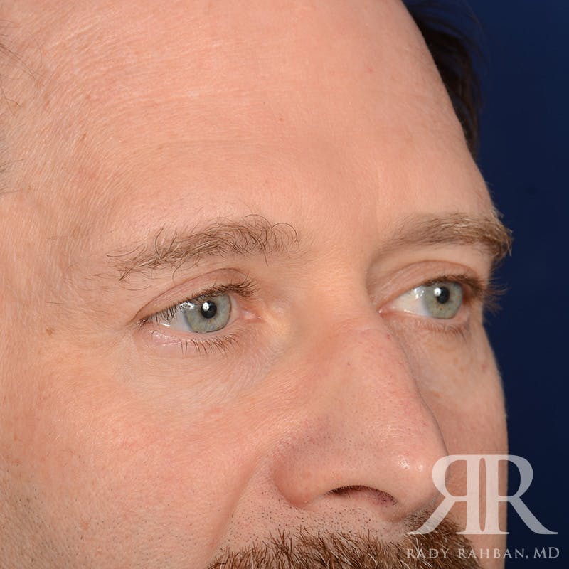 Browlift Before & After Gallery - Patient 300062 - Image 4
