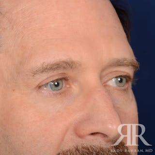 Browlift Before & After Gallery - Patient 300062 - Image 4