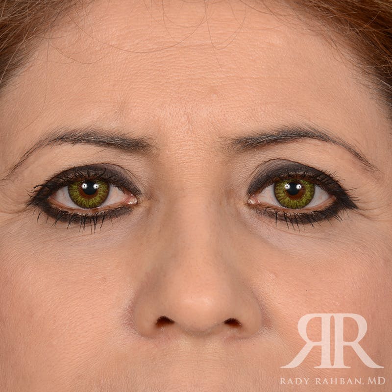 Browlift Before & After Gallery - Patient 117711 - Image 1