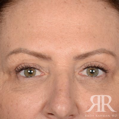 Browlift Before & After Gallery - Patient 201278 - Image 1