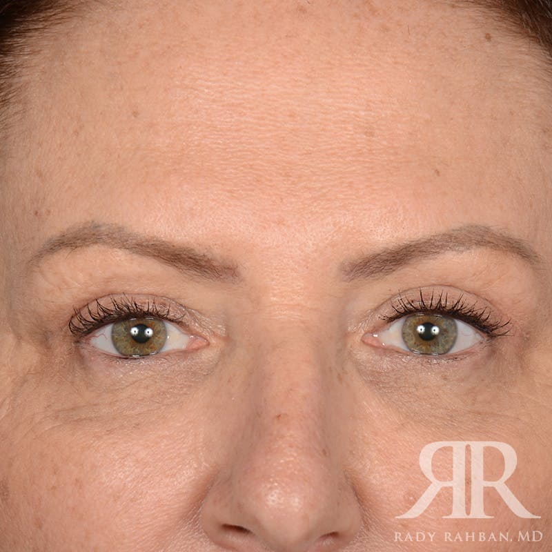 Browlift Before & After Gallery - Patient 201278 - Image 1