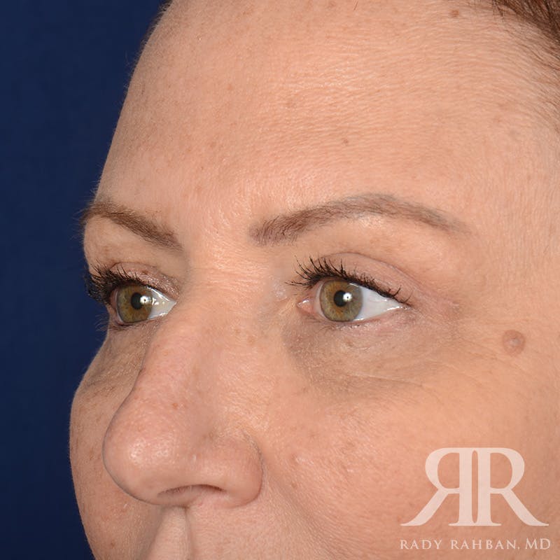 Browlift Before & After Gallery - Patient 201278 - Image 3