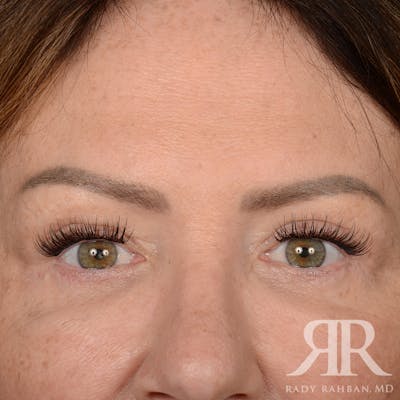 Browlift Before & After Gallery - Patient 201278 - Image 2