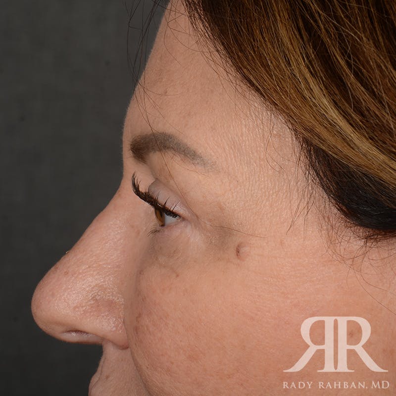 Browlift Before & After Gallery - Patient 201278 - Image 6